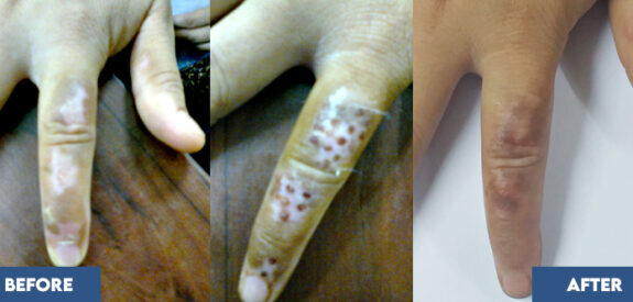 Miniature Punch Grafting for Vitiligo on fingers