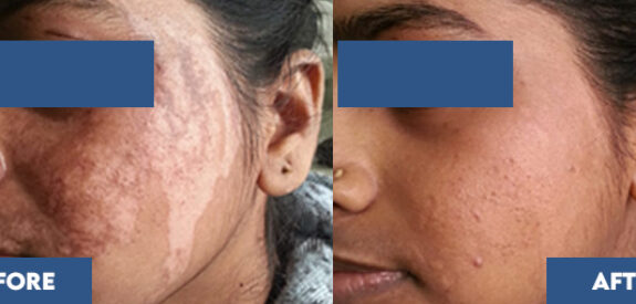 Phototherapy for vitiligo